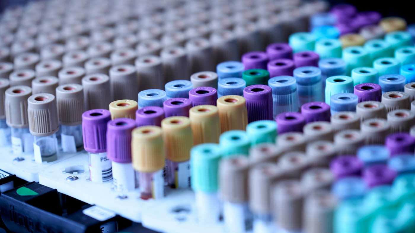 Triglicéridos altos: tubos de recogida de sangre con tapones de colores en una gradilla de laboratorio